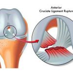 artroscopia-de-rodilla-2