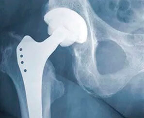 protesis-total-de-cadera