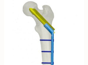 tratamiento-fracturas